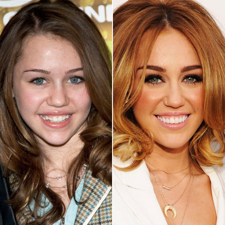 Зубы звезд до и после: сравни фотографии