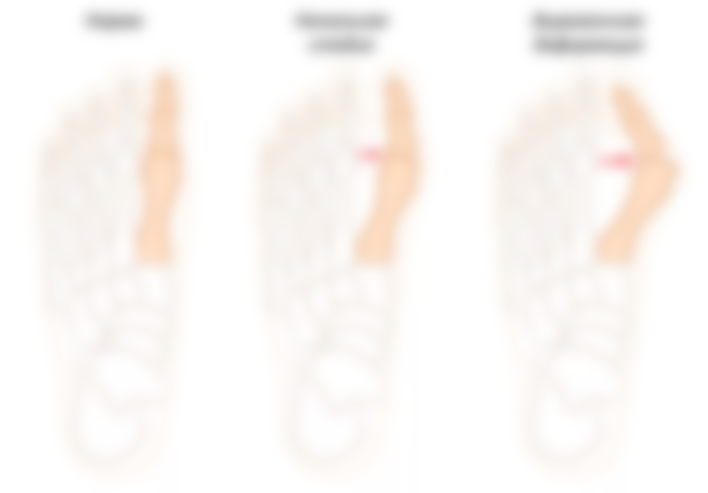 Лечение шишек на суставах большого пальца ноги thumbnail