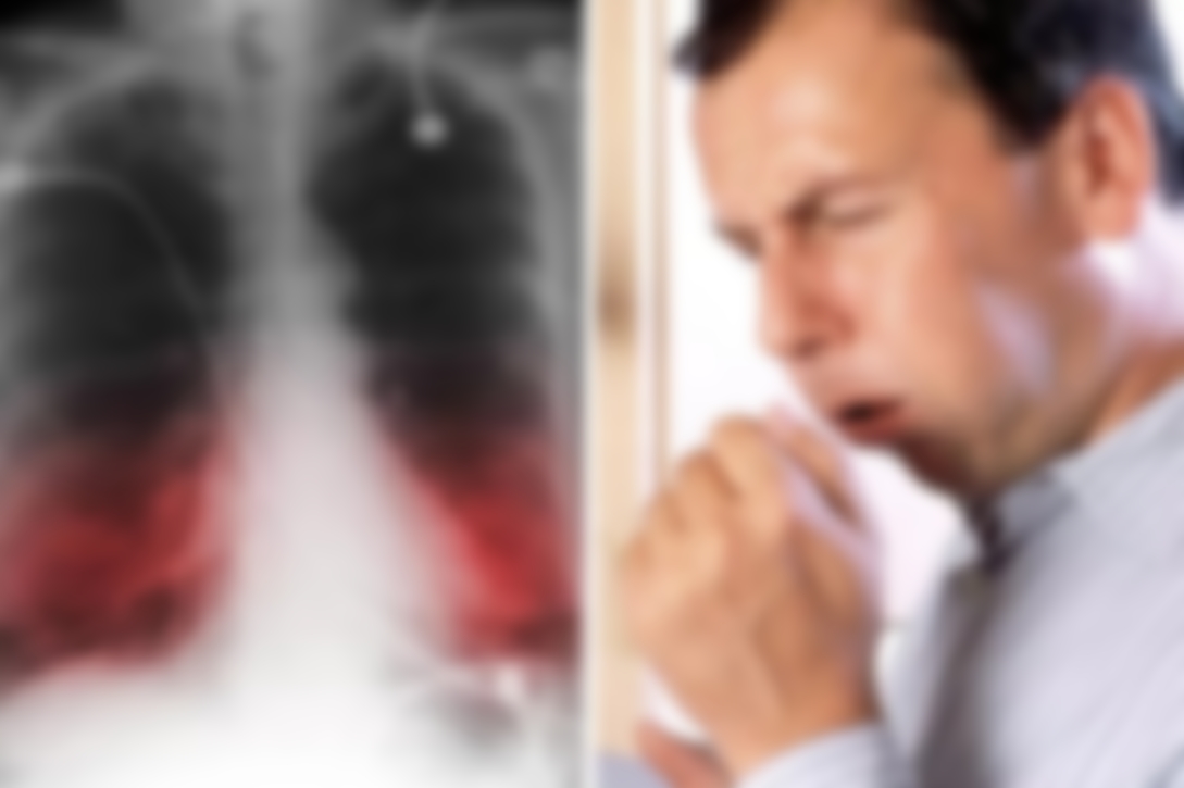 Может ли пневмония протекать без температуры и без кашля