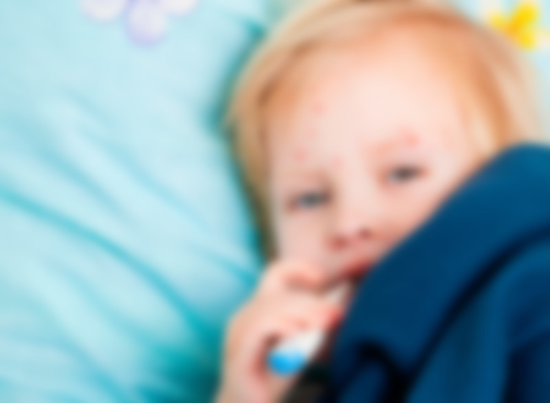 Корь у ребенка фото симптомы и лечение у взрослых thumbnail