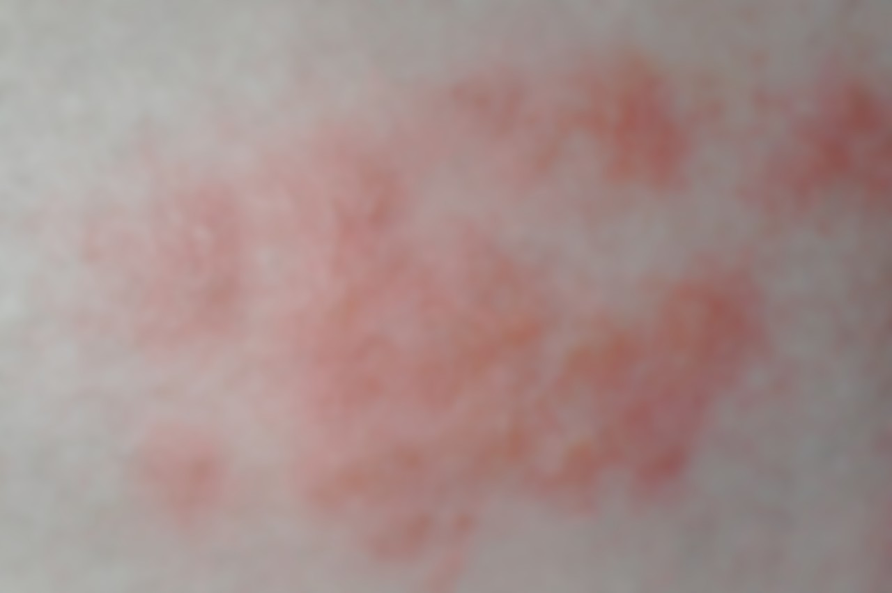 Красные пятна при аллергии фото