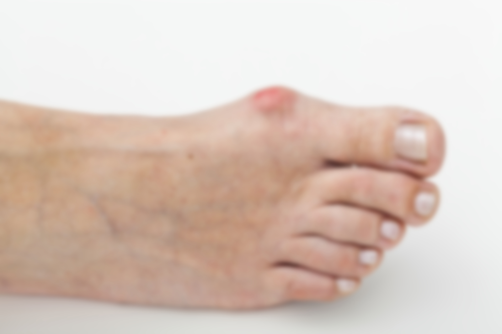 Лечение шишек на суставах большого пальца ноги