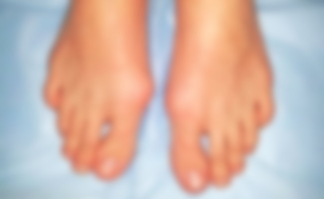 Болит шишка на ноге на большом пальце ноги лечение