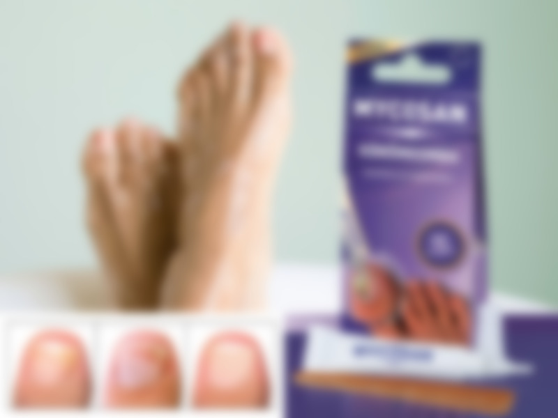 Как вылечить грибок ногтей на ногах лекарства отзывы thumbnail