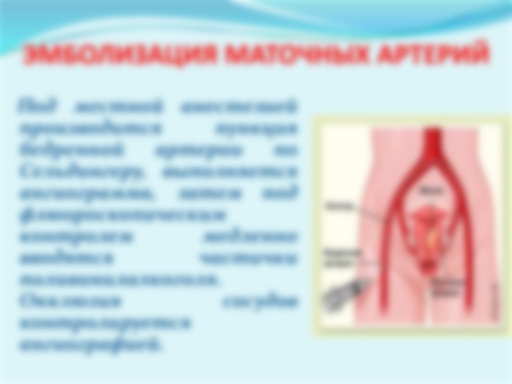 Миома матки с куриное яйцо thumbnail
