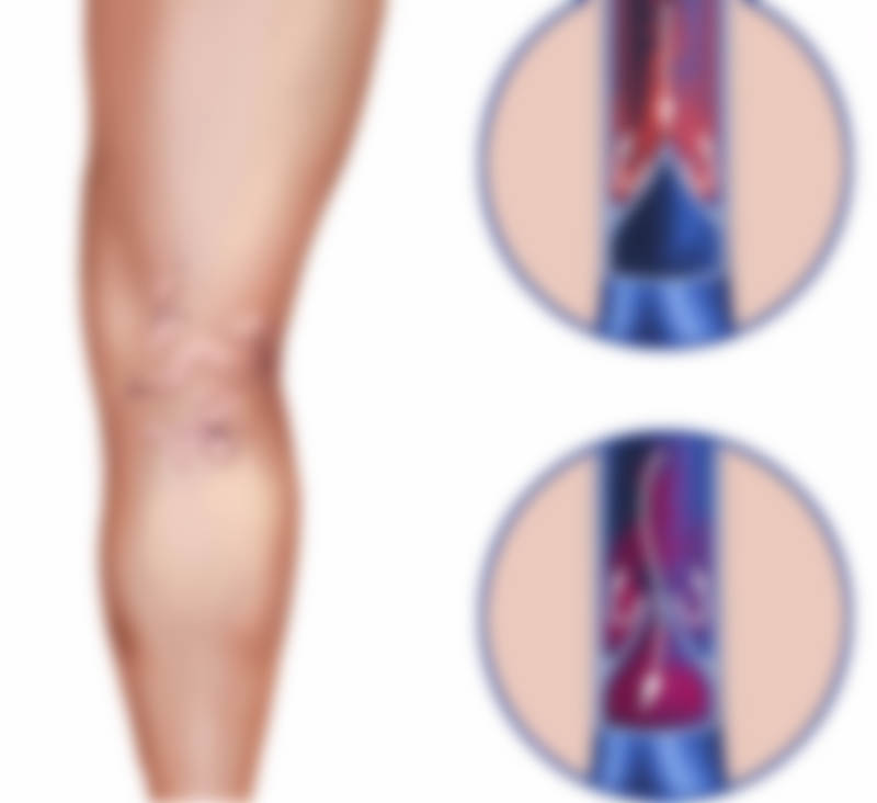 Как лечить варикозное расширение вен на ногах у женщин в домашних условиях:  лучшие способы