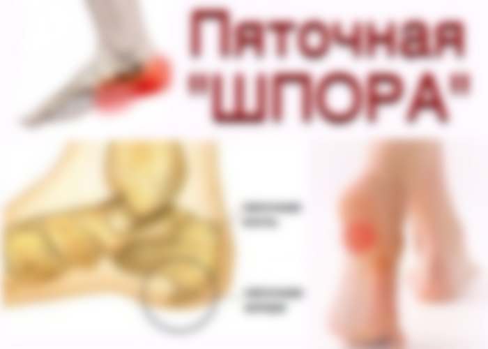 Пяточная Шпора Фото Как Выглядит Пяточная Шпора Фото Как Выглядит