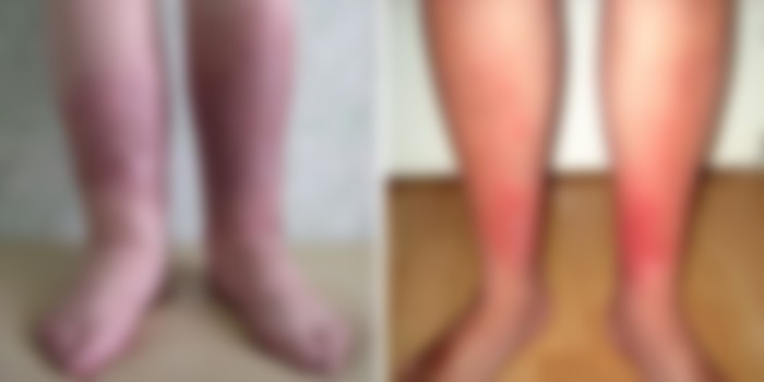 Как Выглядит Рожистое Воспаление На Ноге Фото