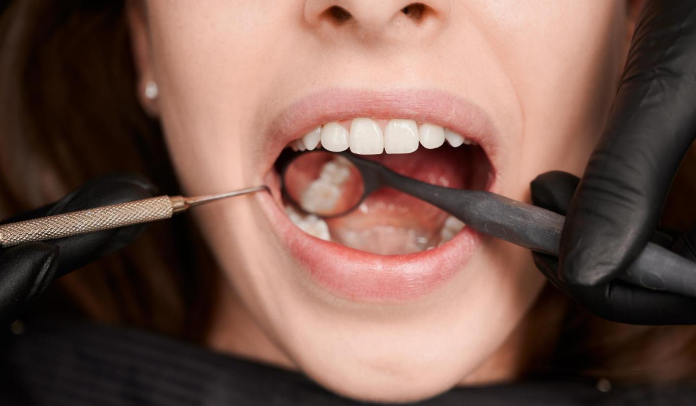 7 причин, по которым развивается кариес (и как заметить его вовремя)