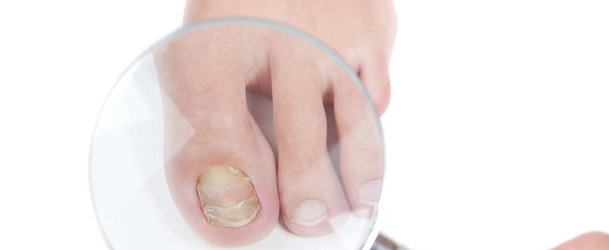 Как быстро избавиться от грибка ногтей: как лечить заболевание