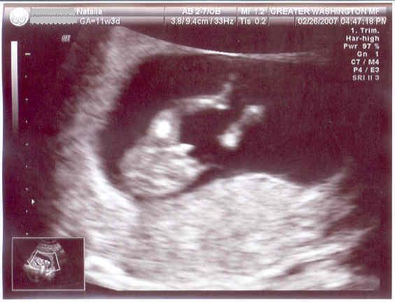 19 неделя 2023. УЗИ 19 недель беременности мальчик.